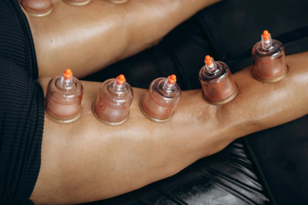 Studerende atlet får cupping-behandling hos fysioterapeuten